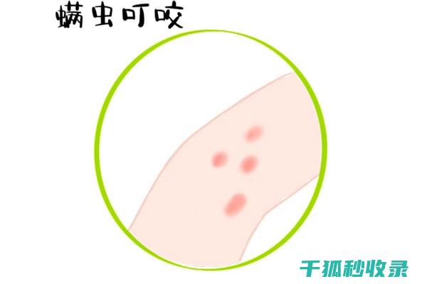 蚊虫叮咬后的止痒方法，这些你一定用得上 (蚊虫叮咬后的黑印子怎么去除)