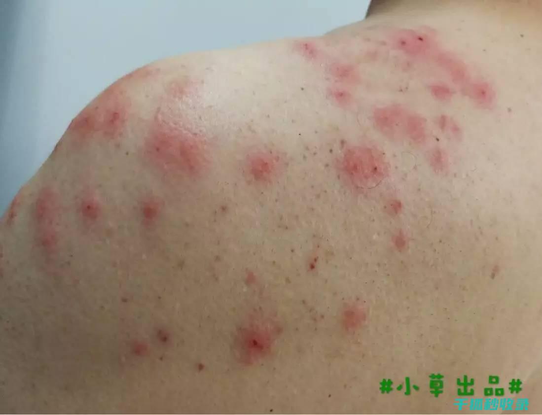 蚊虫叮咬后的止痒技巧，这些你值得一看 (蚊虫叮咬后的图片)