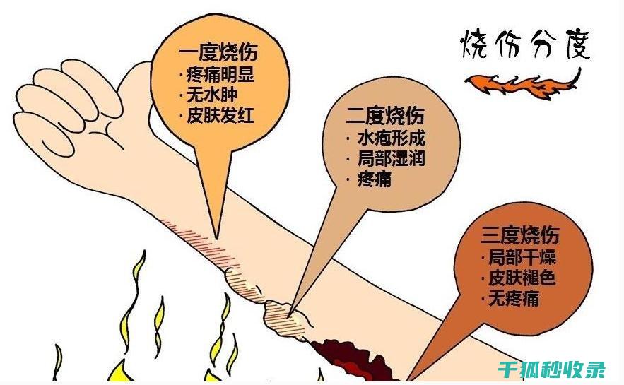 面对轻微烫伤，你准备好了吗？这些处理技巧不容错过 (轻微 烫伤)